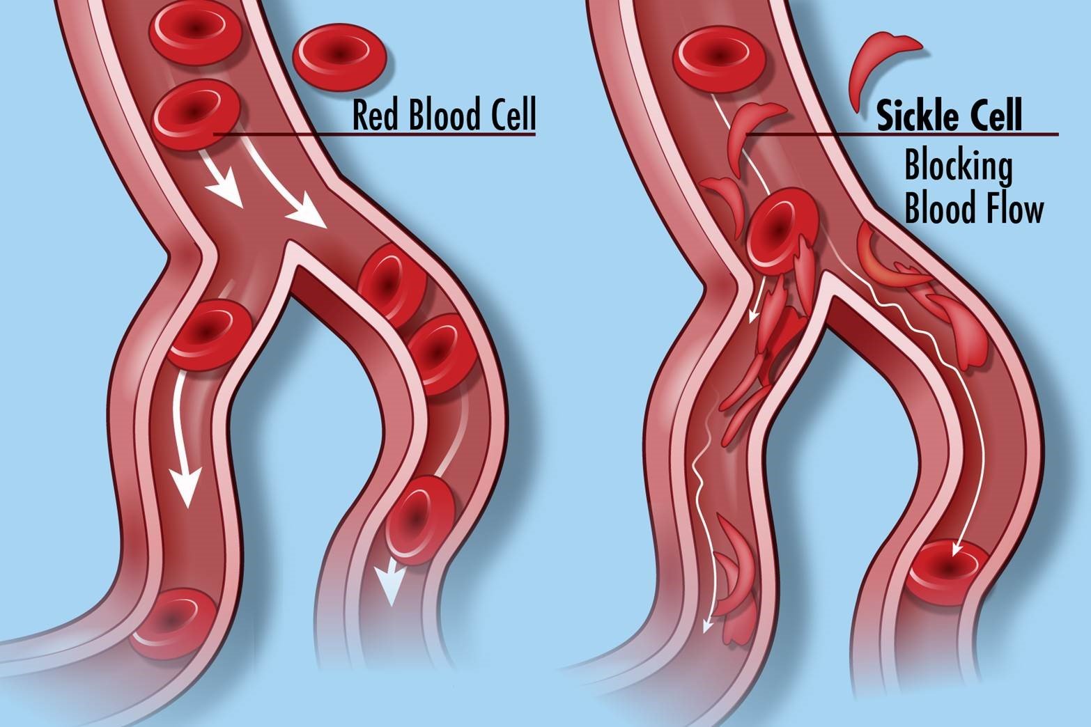 Diagram comparing normal red blood cells flowing smoothly through a vessel with sickle-shaped cells blocking blood flow